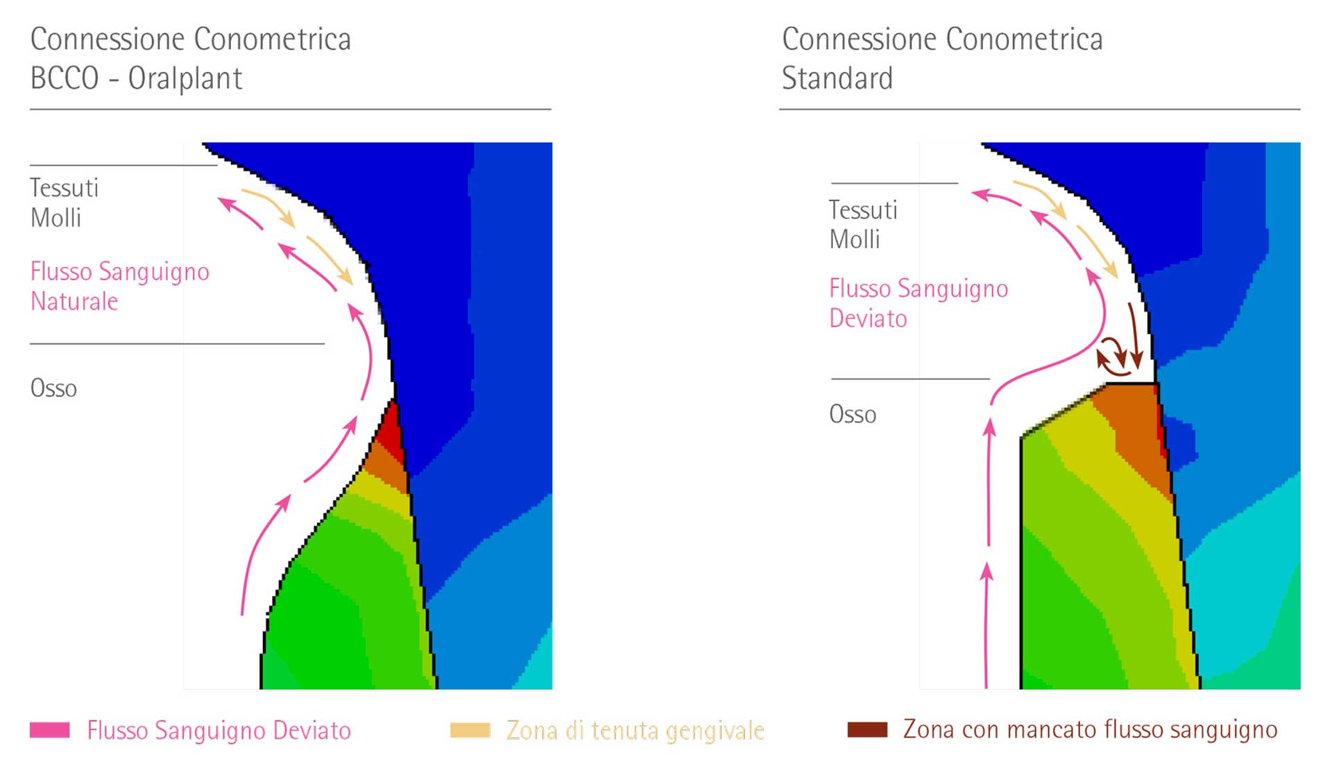 Studio comparativo per la Sollecitazione a Stress  tra connessione BCCO e Cone Morse con metodo ad elementi finiti FEM.